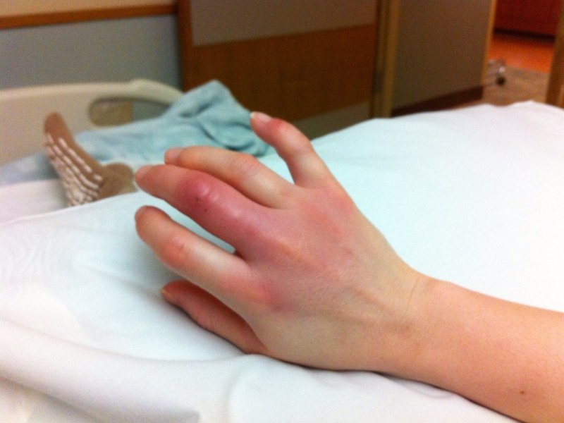 Опухлий палець може бути ознакою туберкульозу